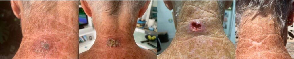 Metasomer Neck Healing