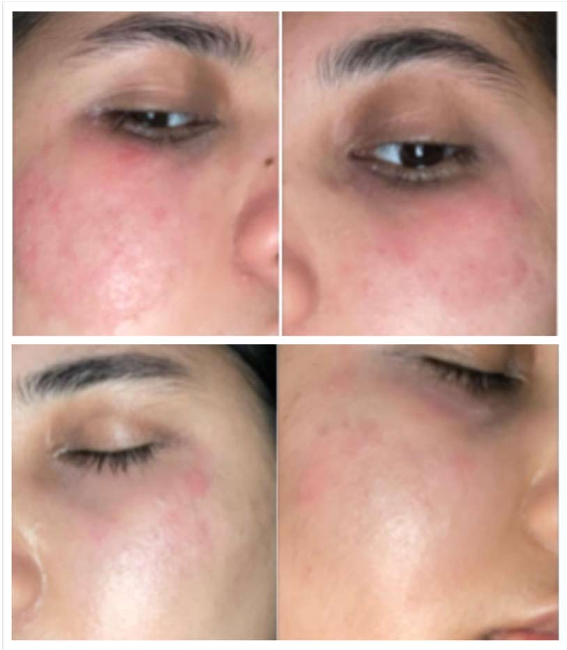 Two Weeks eczema